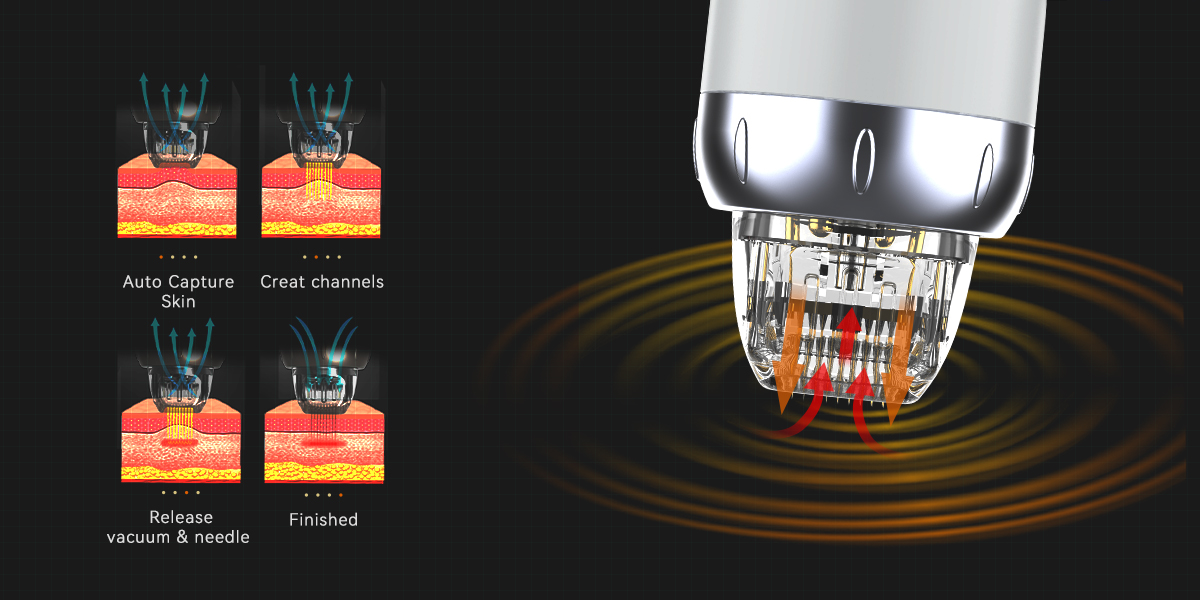 Radiofrequency Microneedling: A Revolutionary Approach to Skin Tightening and Rejuvenation