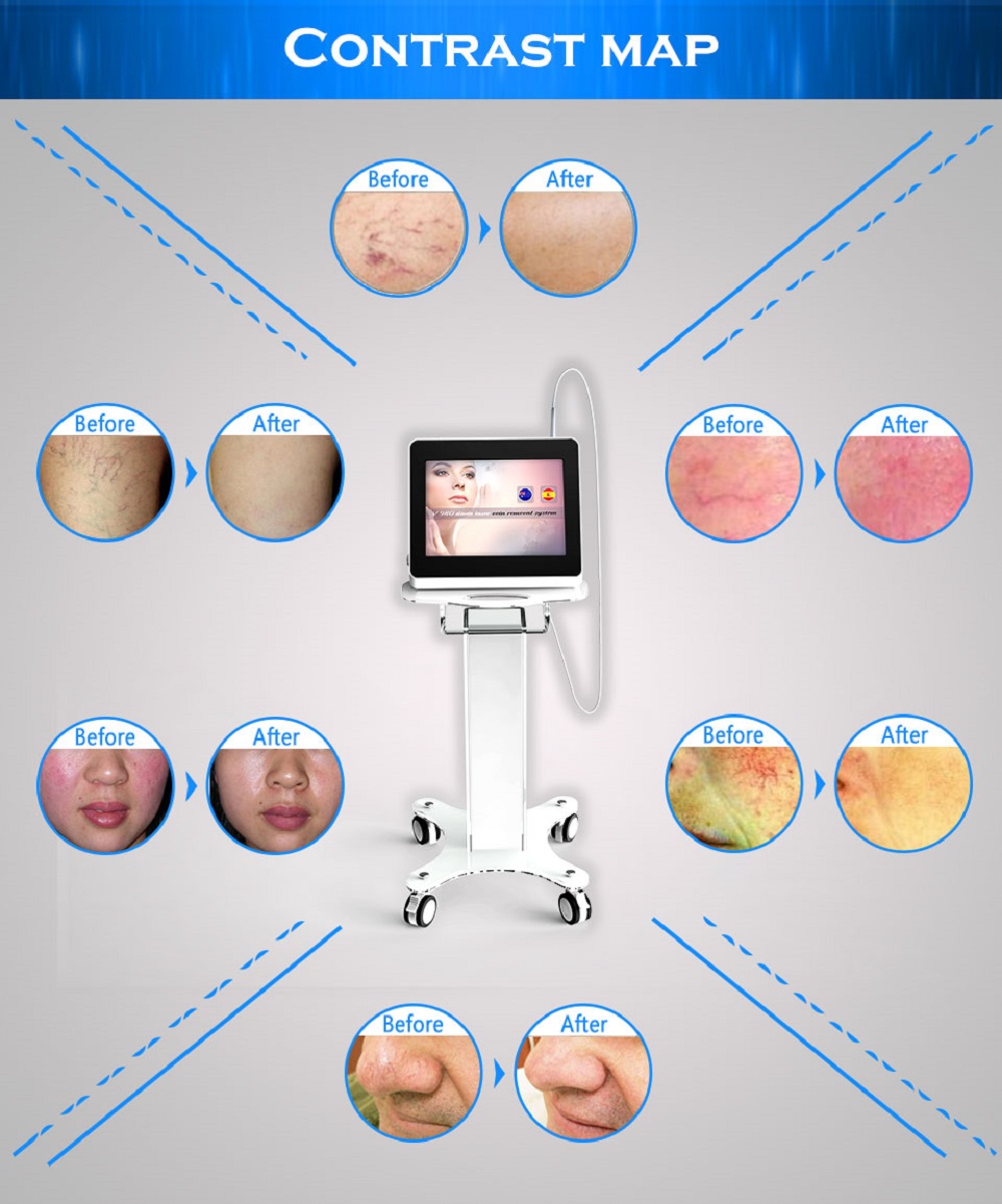 980nm Diode Laser for Vascular Spider Veins Blood Vessels Removal Machine (2)